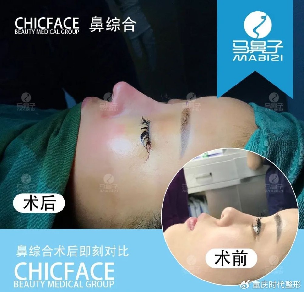 马鼻子告诉你隆鼻后为什么鼻尖发红及处理办法
